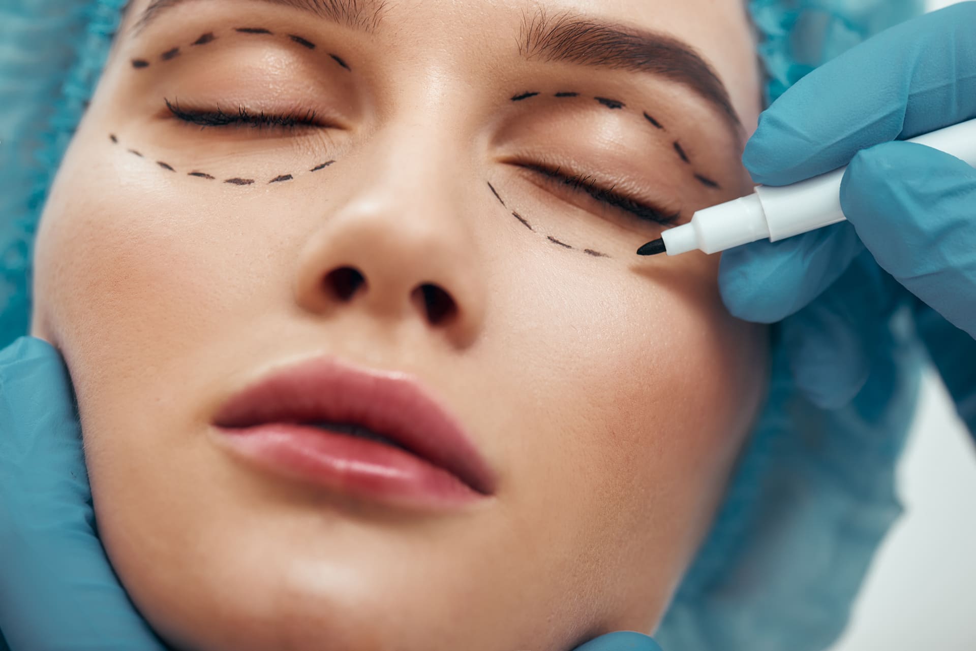 BLEPHAROPLASTY (Eyelid surgery)