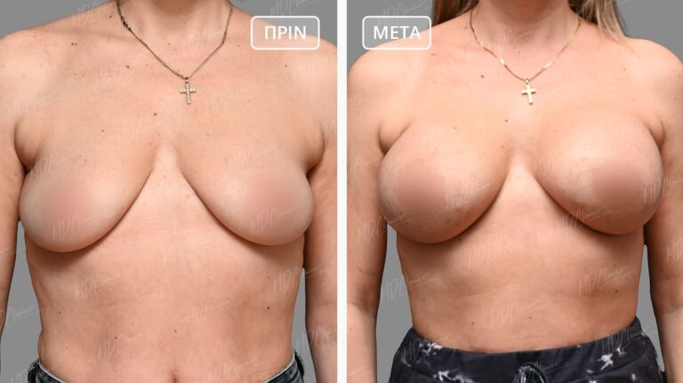 Αυξητική Στήθους Αποτελέσματα Before-After