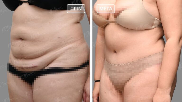 Κοιλιοπλαστική Αποτελέσματα Before-After