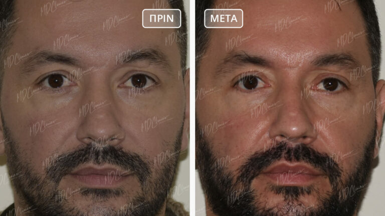 Βλεφαροπλαστική Αποτελέσματα Before-After