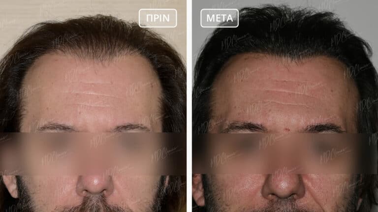 Μεταμόσχευση Μαλλιών FUE Αποτελέσματα Before-After