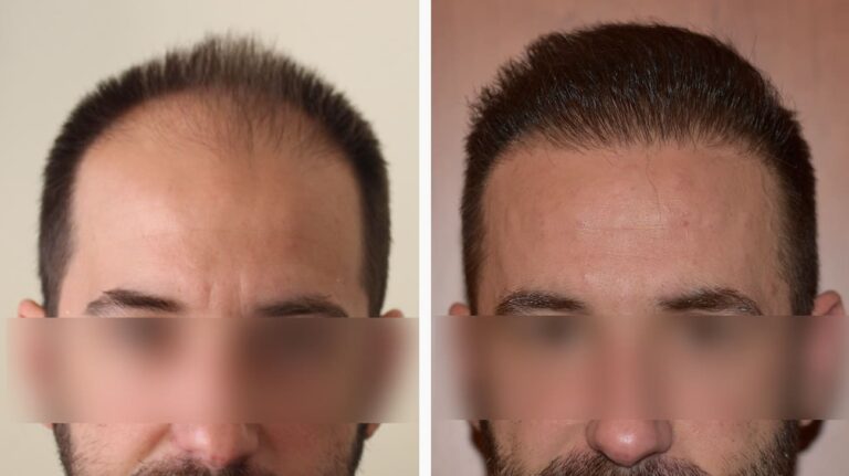 Μεταμόσχευση Μαλλιών FUE Αποτελέσματα Before-After