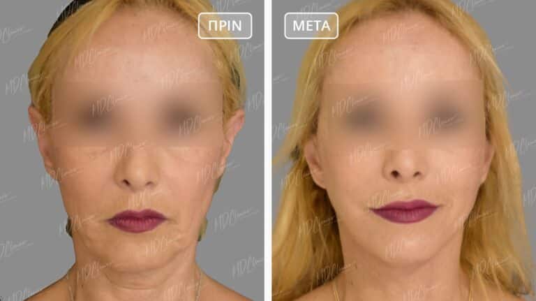 Facelift Αποτελέσματα Before-After