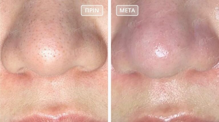 Hydrafacial Αποτελέσματα Before-After