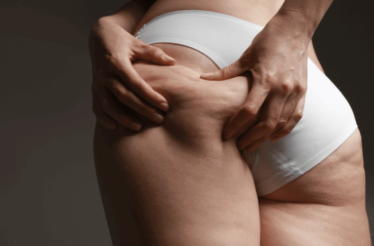 fotona tightsculpting Τι ειναι η χαλαρωση